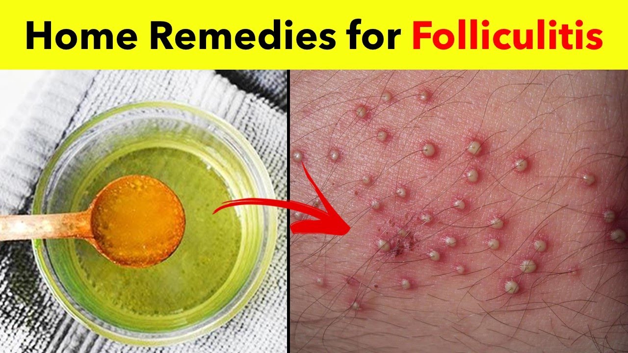 3 Powerful Home Remedies For Folliculitis Best Folliculitis Treatment