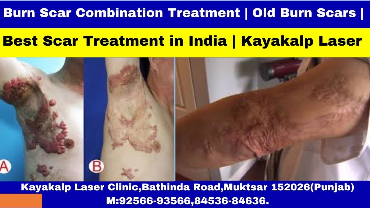 Burn Scar Combination Treatment | Old Burn Scars | Best Scar Treatment in India | Kayakalp Laser