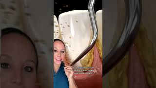 What happens during a dental cleaning?