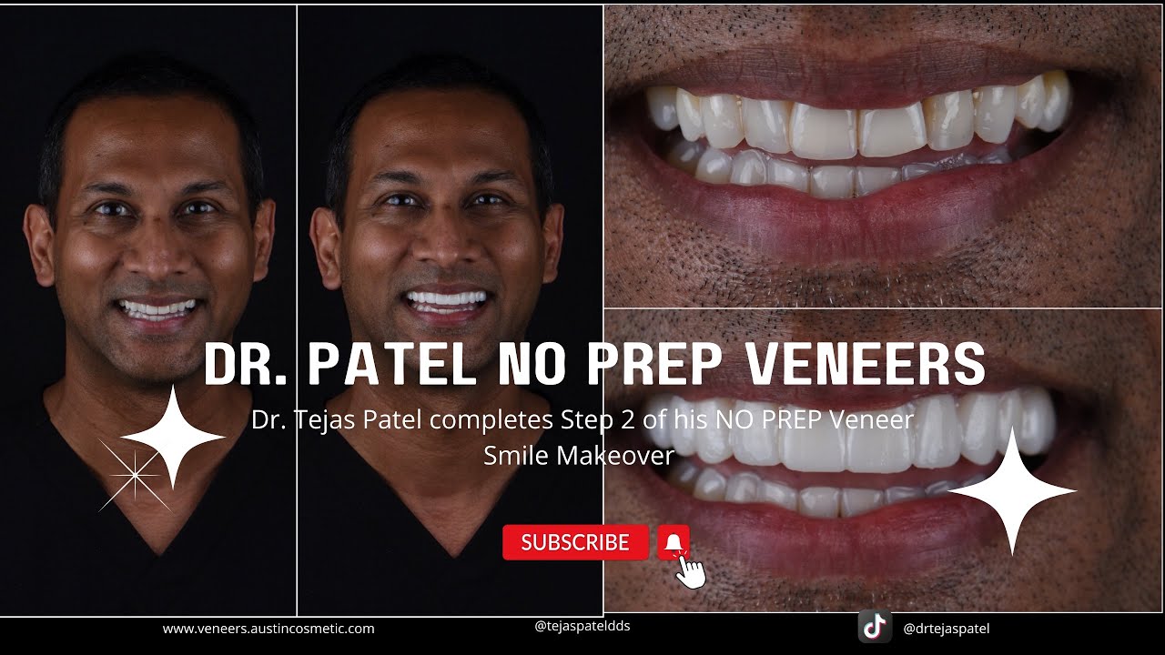 Dr. Tejas Patel gives himself NO PREP Veneers - Part 1