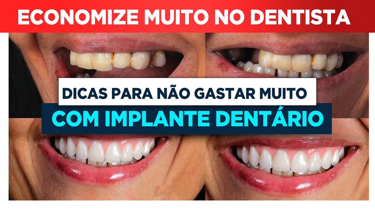 Como NÃO PAGAR um PREÇO MUITO ALTO no Implante Dentário