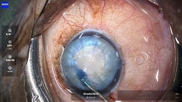 Spiral Rhexis For Intumescent Cataracts