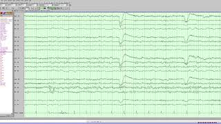Breach rhythm