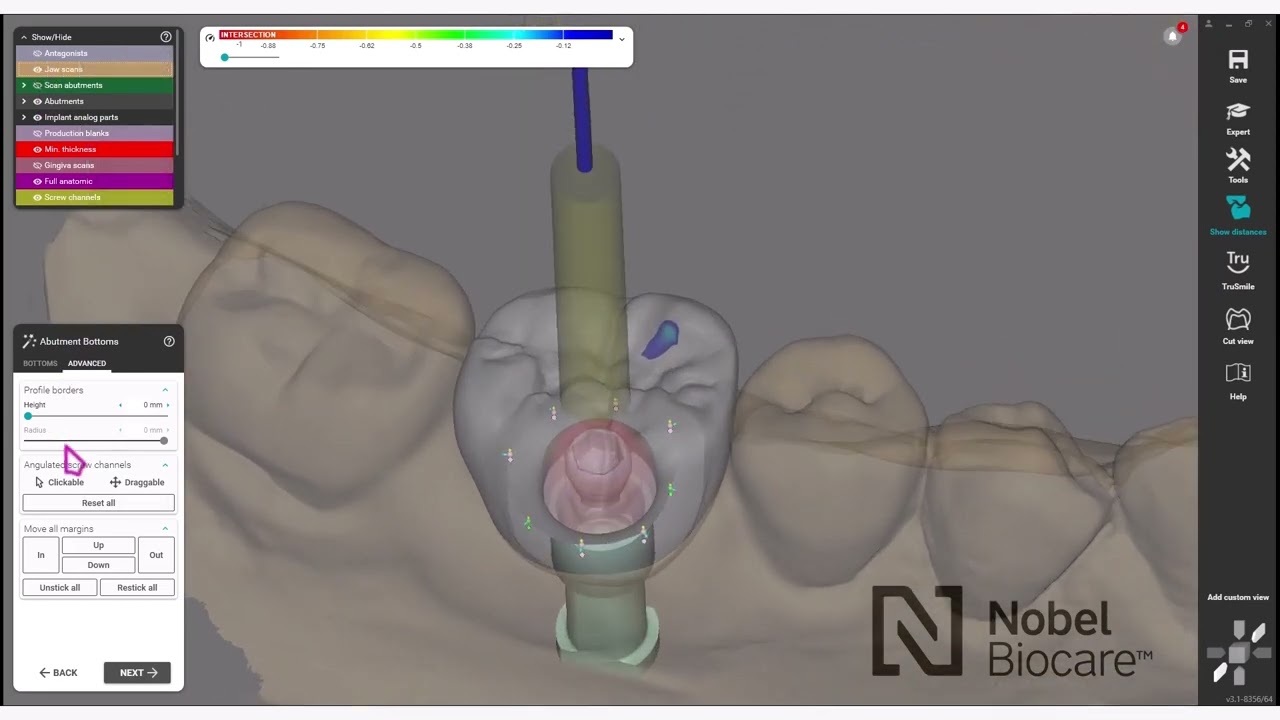 How to design your NobelProcera® Full-contour Zirconia Implant Crown using exocad™