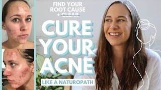 FIND THE ROOT CAUSE OF YOUR ACNE (Only Way to CURE Acne for Good!)