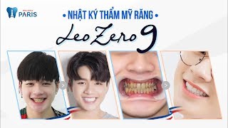 Nhật Ký Bọc Răng Sứ - Ca Sĩ Leo Nhóm Zero 9 Nha Khoa Paris