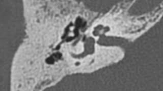 Otosclerosis Imaging Explained: A Comprehensive Overview