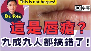 (AI中文字幕/Eng Sub)嘴角出現這種問題，其實不是唇瘡？this is not herpes!