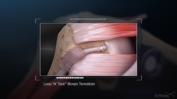 Loop ‘N’ Tack™ Biceps Tenodesis