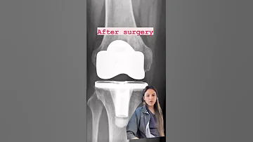 Joint Space After Total Knee Replacement 