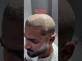 High Density Hair Transplant Result frontal hairline & side angle coverage with outstanding density