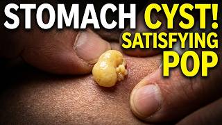 Removing a Sebaceous Cyst From My Stomach | Steatocystoma Multiplex