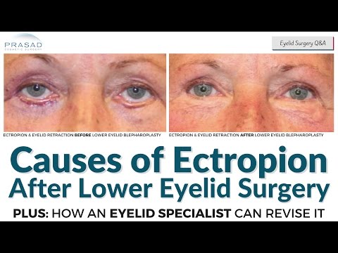 Causes of Ectropion after Lower Eyelid Surgery, and Possible Restoration by an Eyelid Specialist