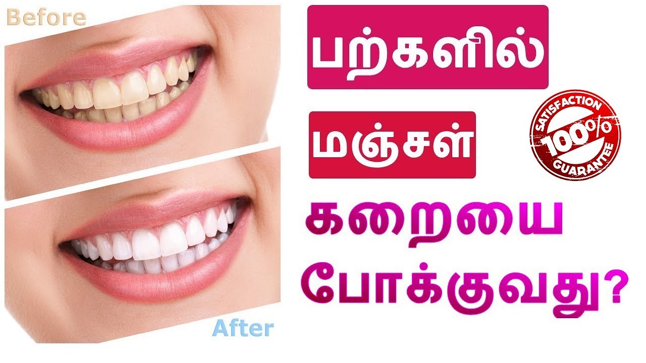 பற்களில் படிந்திருக்கும் மஞ்சள் கறையை போக்குவது ? How To Whiten Teeth