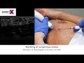 Breast biopsy and marking 1