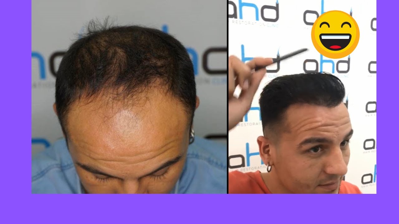 3500 графтов | 