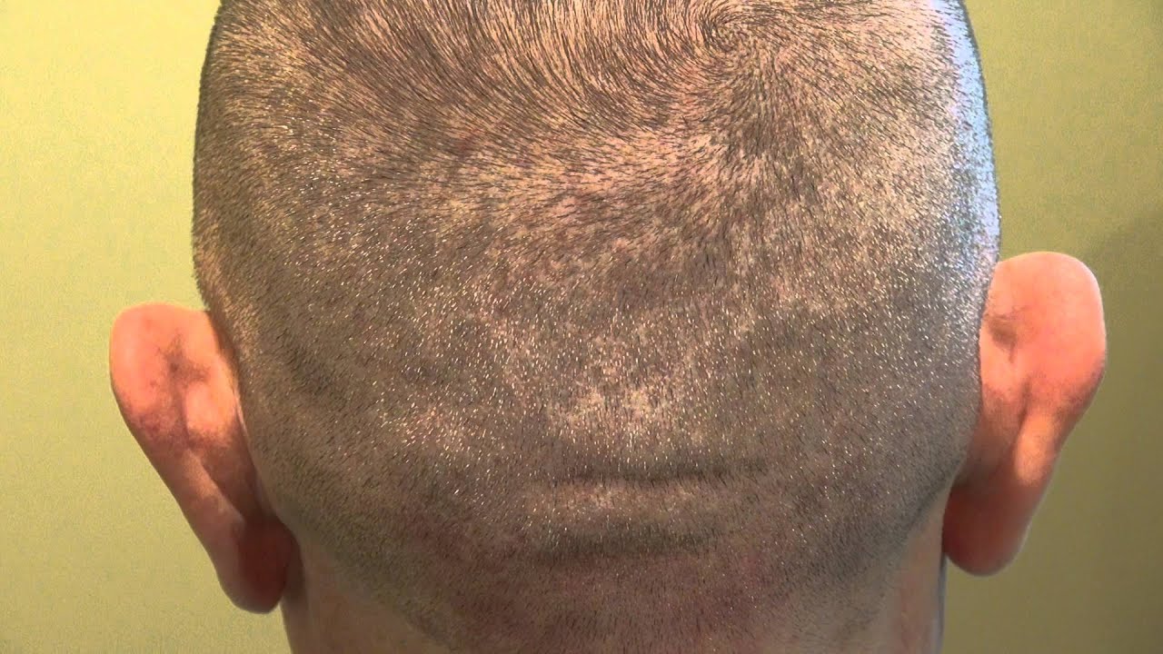 Донорская зона после пересадки. Шрамы после пересадки волос. Пересадка волос на голове у мужчин. Донорская зона для пересадки волос.