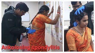 Ankylosing spondylitis treatment.