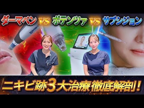 【結論】ニキビ跡に一番効く治療はどれ？ダーマペンvsポテンツァvsサブシジョン 徹底比較！
