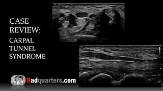 Ultrasound of Carpal Tunnel Syndrome