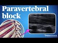 Ultrasound guided thoracic paravertebral block