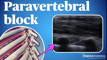 Ultrasound guided thoracic paravertebral block