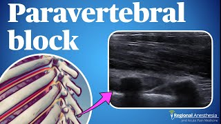 Ultrasound guided thoracic paravertebral block