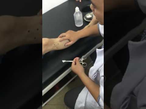 Video Huyệt túc tam lý cách xác định và châm huyệt - youtube