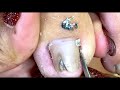 How to Repair Nails easy #174 - Xuyen Nail