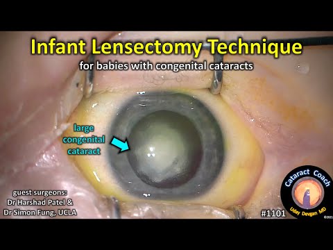 CataractCoach 1101: infant lensectomy for baby with congenital cataracts