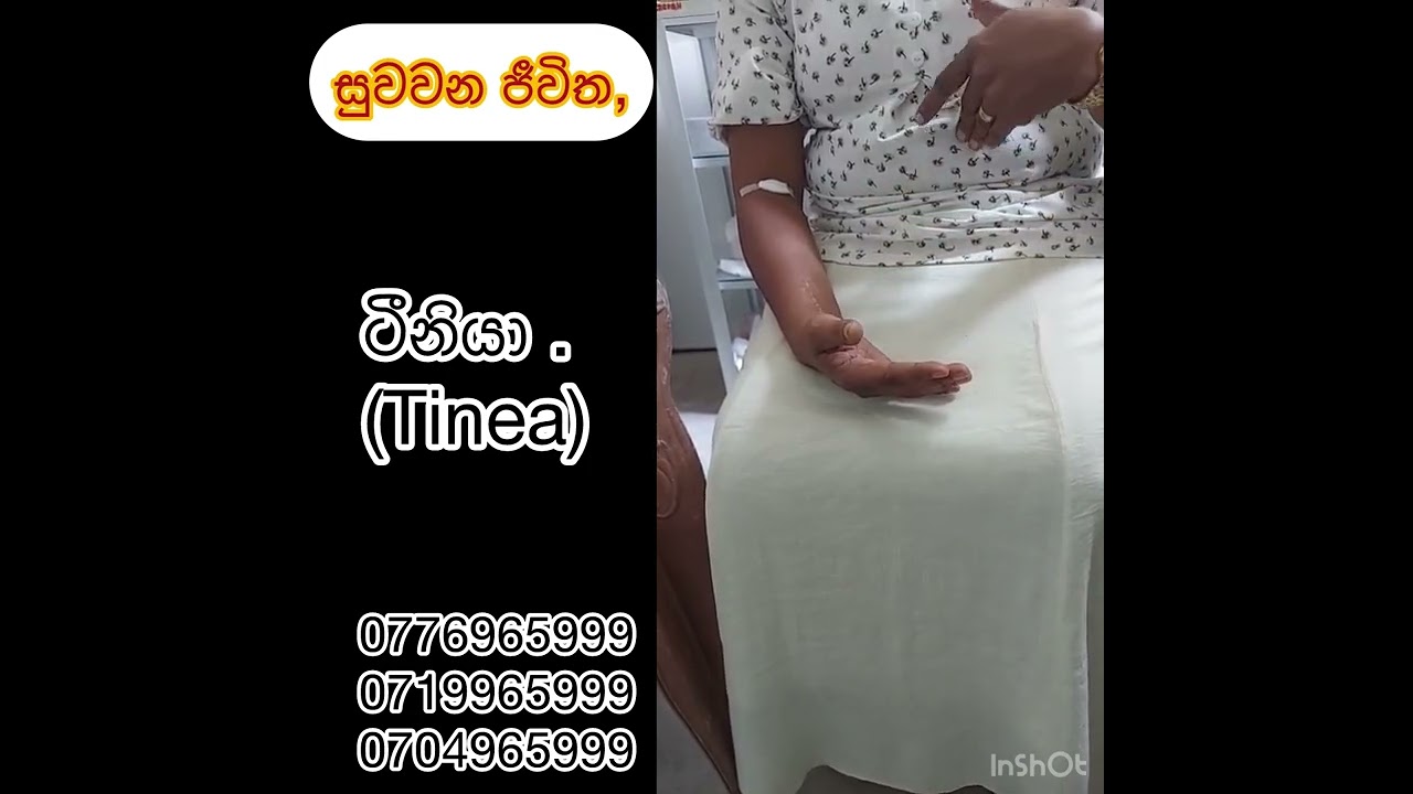 #ටීනියා #tinea තවමත් සුව කරගන්න  බැරි වුනාද?මේ මිනිස්‍සු කියන් දේ බලන්න👆👆👆