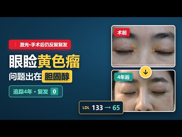 眼睑黄色瘤,为什么去了又长?问题出在胆固醇(4年追踪)#眼睑黄色瘤 #睑黄瘤 #黄色瘤 #xanthelasma #胆固醇 #低密度脂蛋白 #血脂异常 #高血脂 #眼部整形 #延世自然美