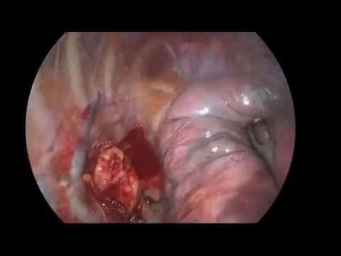 esophageal leiomyoma resection through a uniportal VATS