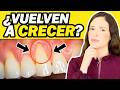 ¿Se Pueden Regenerar Las Encías Retraídas En Casa? La Verdad Clínica Sin Milagros