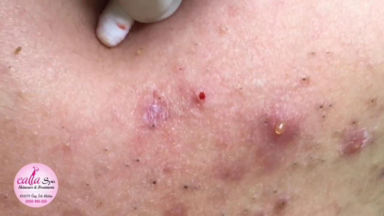 #40# blackhead