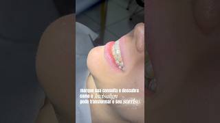 Aparelho a Invisalign: Estética e função trabalhando juntos! #campinagrande #dentista #invisalign