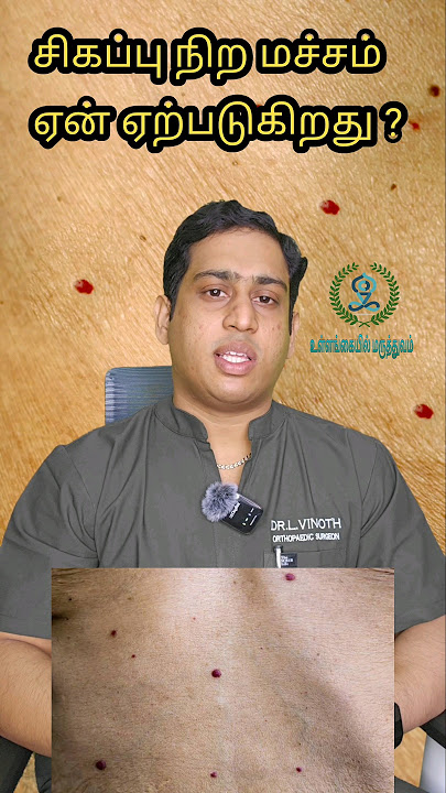 சிவப்பு நிற மச்சம் ஏன் ஏற்படுகிறது|Cherry angioma|Red spots on skin|Hemangioma|Red mole #hemangioma