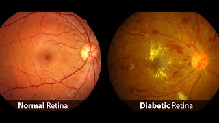 DeepLearning Fundus Image Analysis for Early Detection of Diabetic Retinopathy