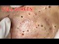 Large blackheads removal  best pimple poppings