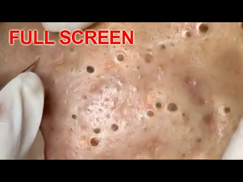 LARGE Blackheads Removal - Best Pimple Popping Videos