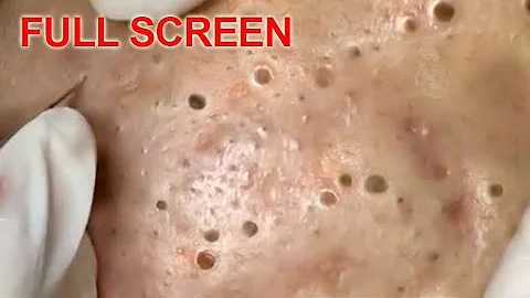 LARGE Blackheads Removal - Best Pimple Popping Vid...