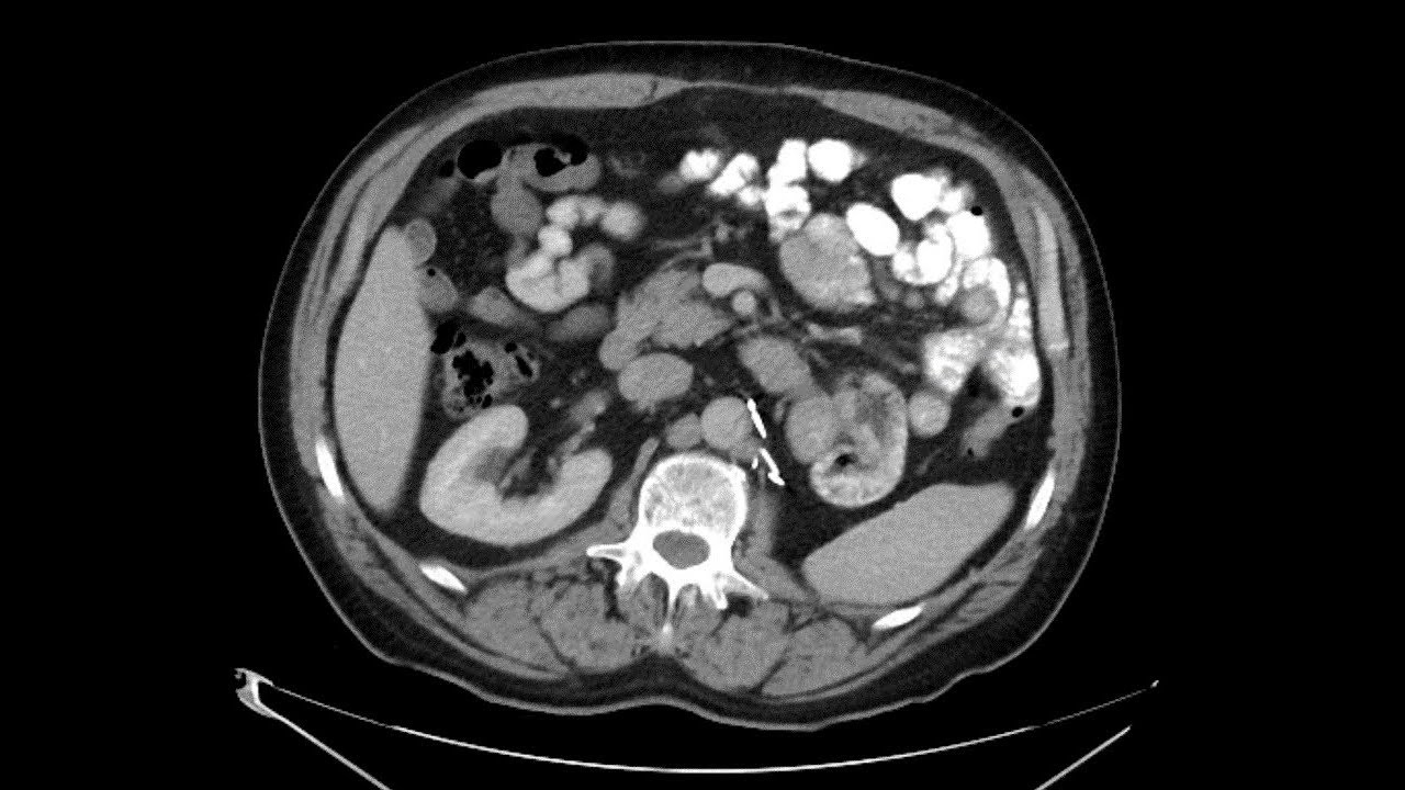 Trial aims to treat kidney cancer tumor before surgery