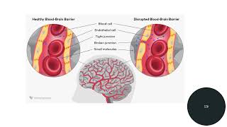 Melanoma and Metastasis to the Brain