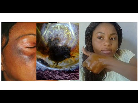Vidéo: Comment enlever le goudron de la peau (avec des images)