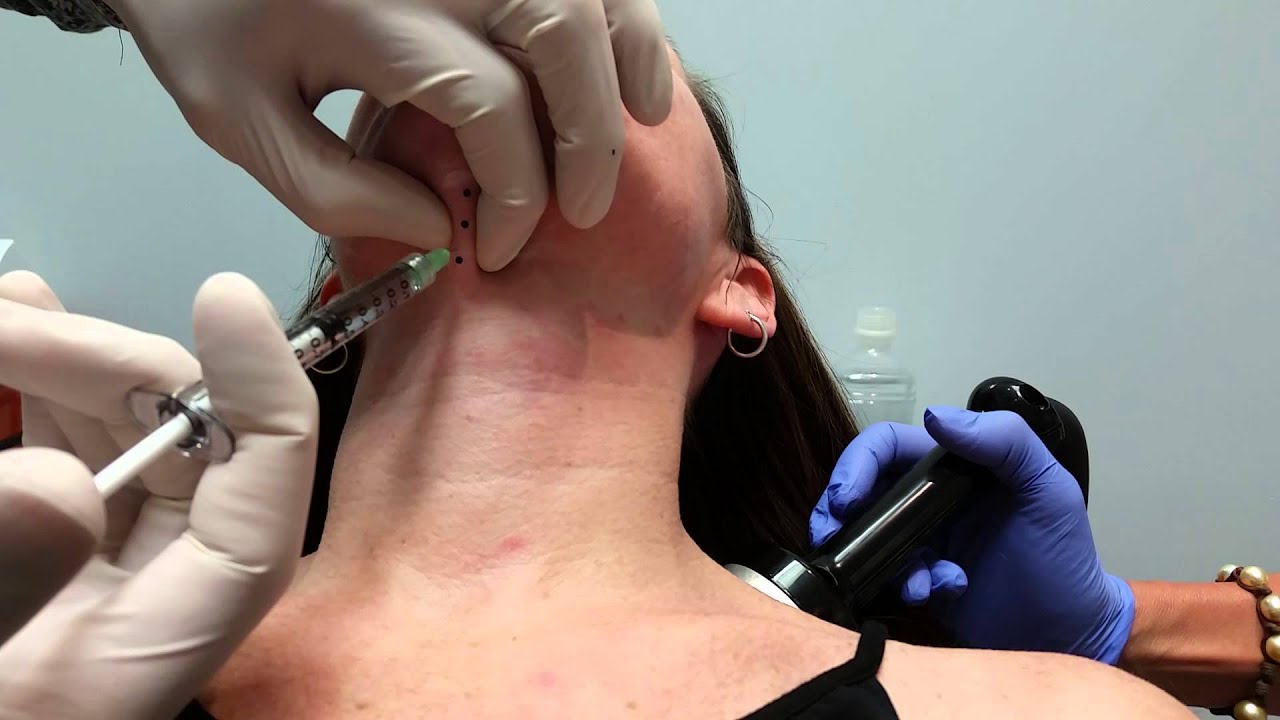 Kybella demonstration by Dr Weiner for Double Chin