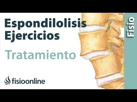 Vídeo: Ejercicios De Espondilolistesis: Para Aliviar El Dolor