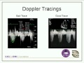 Optimizing Your Echo Images & Doppler Evaluations webcast