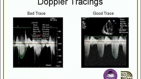 Optimizing Your Echo Images & Doppler Evaluations webcast