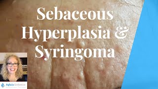 WHAT ARE THESE BUMPS? SEBACEOUS HYPERPLASIA OR SYRINGOMA