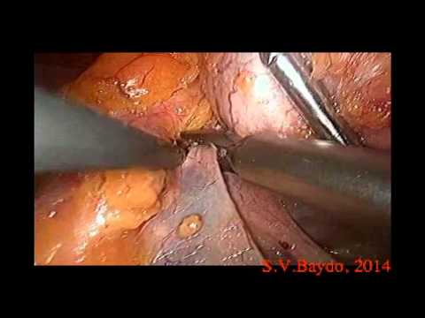 Laparoscopic High Complexity Partial Nephrectomy